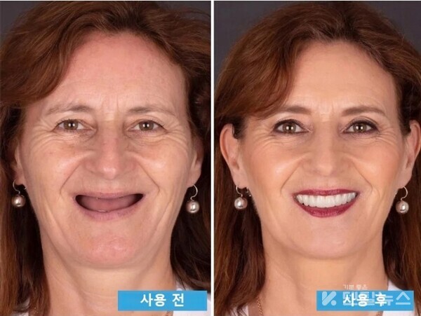 제작틀니 전후 케이스까지 버젓히 공개하면서 환자들을 현혹하고 있다. 덴탈뉴스