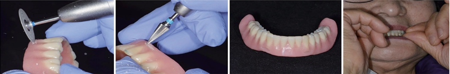 △ (그림 27) 간접법에 의해서 Attachment가 Denture에 연결된 후에 조직면 조정과 교합조정을 해주어야 한다.