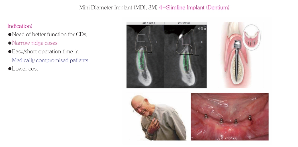 △ (그림 28) Alveolar ridge의 폭이 너무 좁거나, medically compromised patient 인 경우 Mini Diameter Implant overdenture가 좋은 선택 일 수 있다.