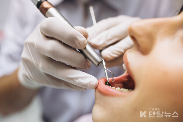 영국 킹스칼리지 런던 연구팀은 치아 신경치료가 건강에 미치는 영향을 확인하기 위한 연구를 진행했다. 덴탈뉴스